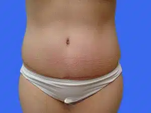 Tummy Tuck before and after photos Tummy Tuck before and after photos