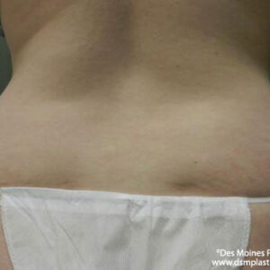 Liposuction before and after photos