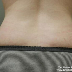 Liposuction before and after photos