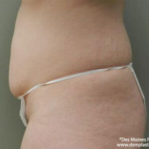 Liposuction before and after photos