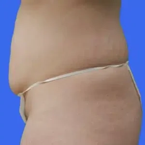 Liposuction before and after photos Liposuction before and after photos