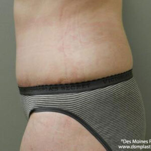 Liposuction before and after photos