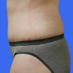 Liposuction before and after photos Liposuction before and after photos