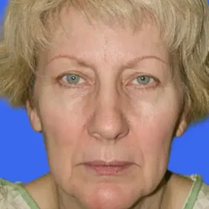 Face Lift before and after photos