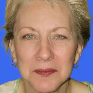 Face Lift before and after photos