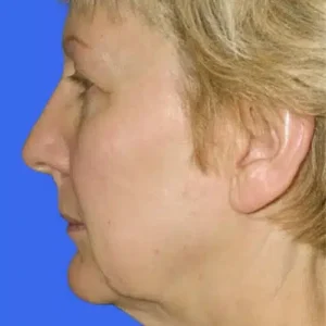 Face Lift before and after photos