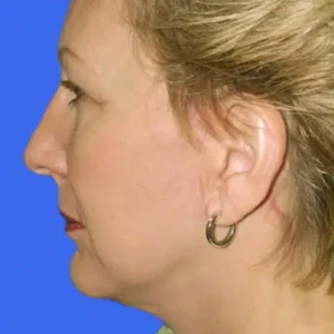 Face Lift before and after photos