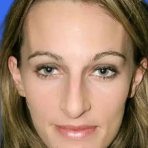 Rhinoplasty before and after photos