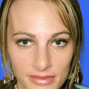 Rhinoplasty before and after photos