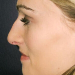 Rhinoplasty before and after photos