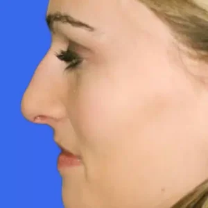 Rhinoplasty before and after photos