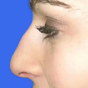 Rhinoplasty before and after photos
