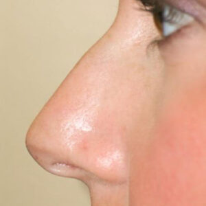 Rhinoplasty before and after photos