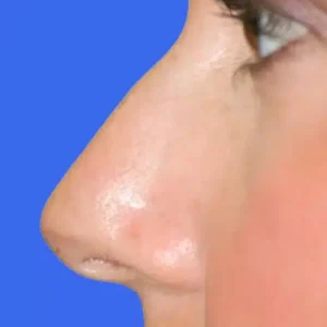 Rhinoplasty before and after photos