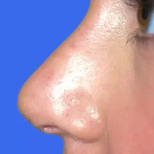 Rhinoplasty before and after photos