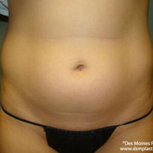 Liposuction before and after photos