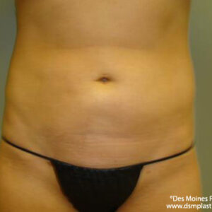 Liposuction before and after photos