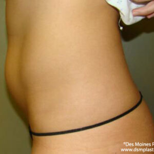 Liposuction before and after photos