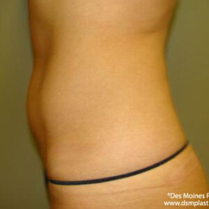 Liposuction before and after photos