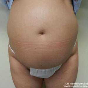 Tummy Tuck before and after photos
