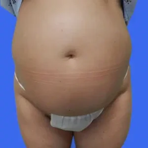 Tummy Tuck before and after photos Tummy Tuck before and after photos