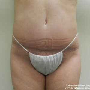 Tummy Tuck before and after photos