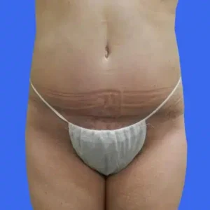 Tummy Tuck before and after photos Tummy Tuck before and after photos