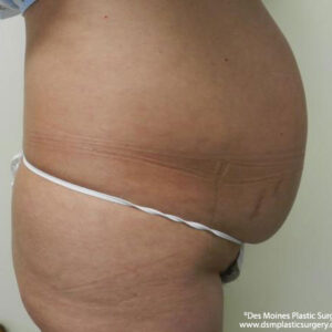 Tummy Tuck before and after photos