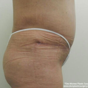 Tummy Tuck before and after photos