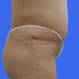 Tummy Tuck before and after photos Tummy Tuck before and after photos