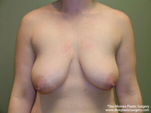 Breast Lift before and after photos