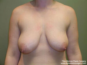 Breast Lift before and after photos