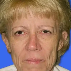 Face Lift before and after photos