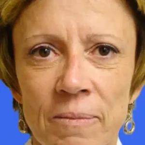 Face Lift before and after photos