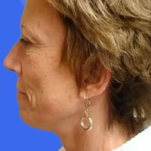 Face Lift before and after photos