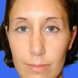 Rhinoplasty before and after photos