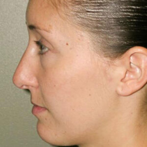 Rhinoplasty before and after photos