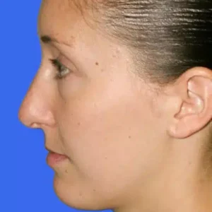 Rhinoplasty before and after photos