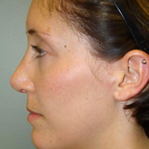 Rhinoplasty before and after photos