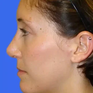 Rhinoplasty before and after photos