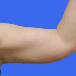 Liposuction before and after photos Liposuction before and after photos