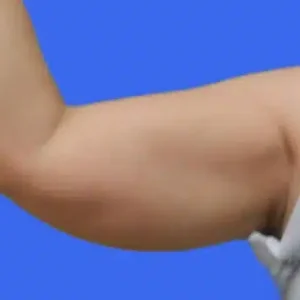 Liposuction before and after photos Liposuction before and after photos