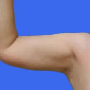 Liposuction before and after photos Liposuction before and after photos