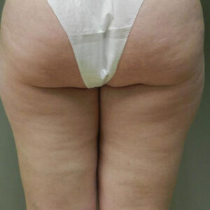 Liposuction before and after photos