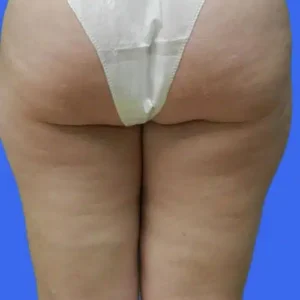 Liposuction before and after photos Liposuction before and after photos
