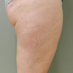 Liposuction before and after photos