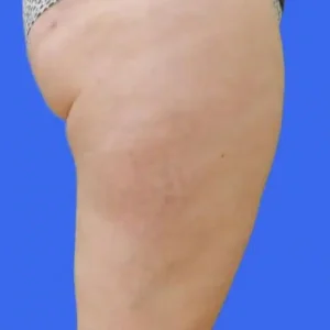 Liposuction before and after photos Liposuction before and after photos