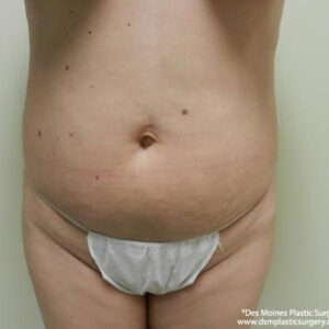 Tummy Tuck before and after photos