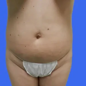 Tummy Tuck before and after photos Tummy Tuck before and after photos