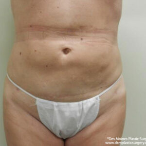 Tummy Tuck before and after photos
